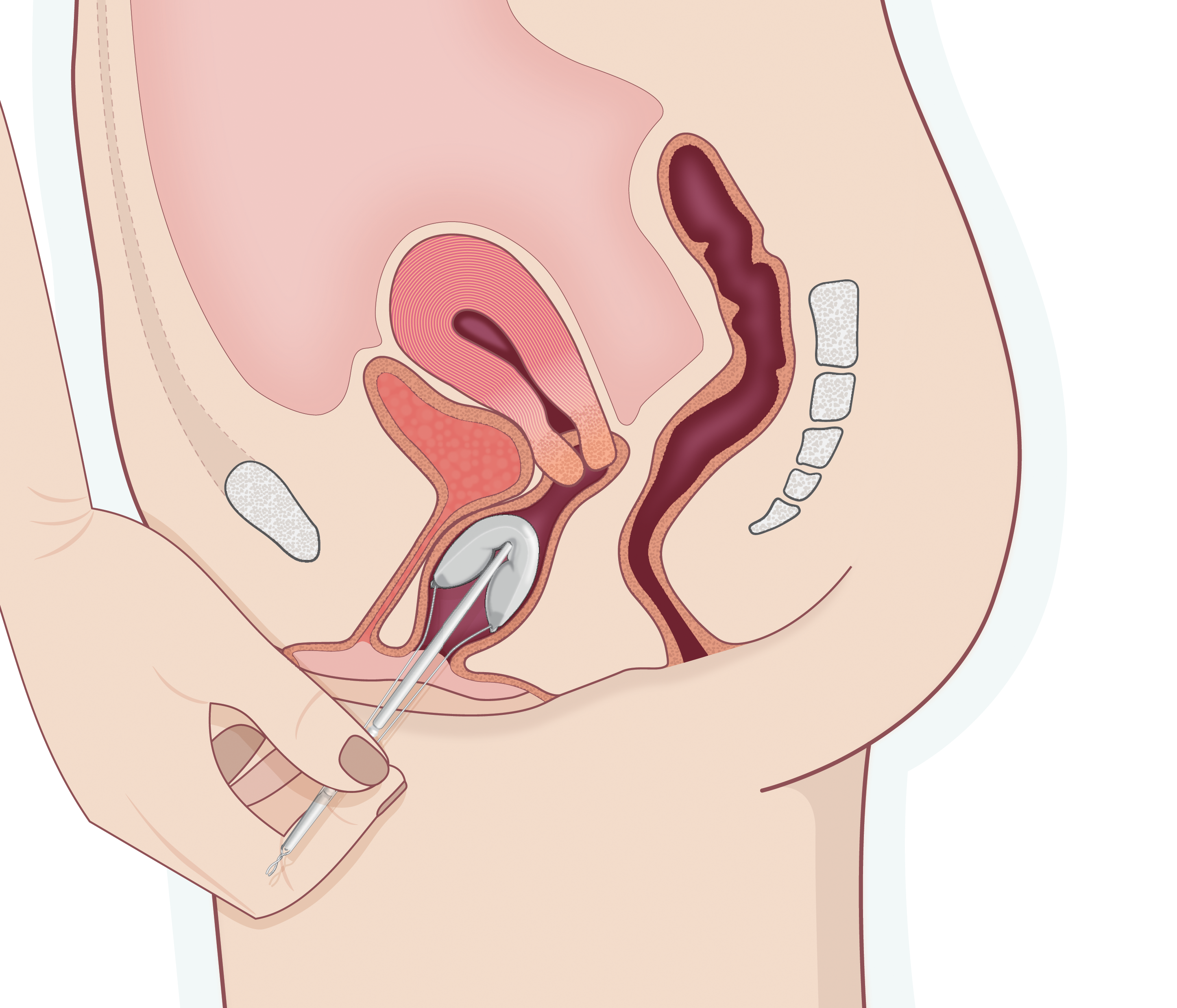 PJRC831_VivecaBiomed(HandInsertion)02